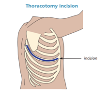 Thoracic Spine Surgery: All You Need to Know